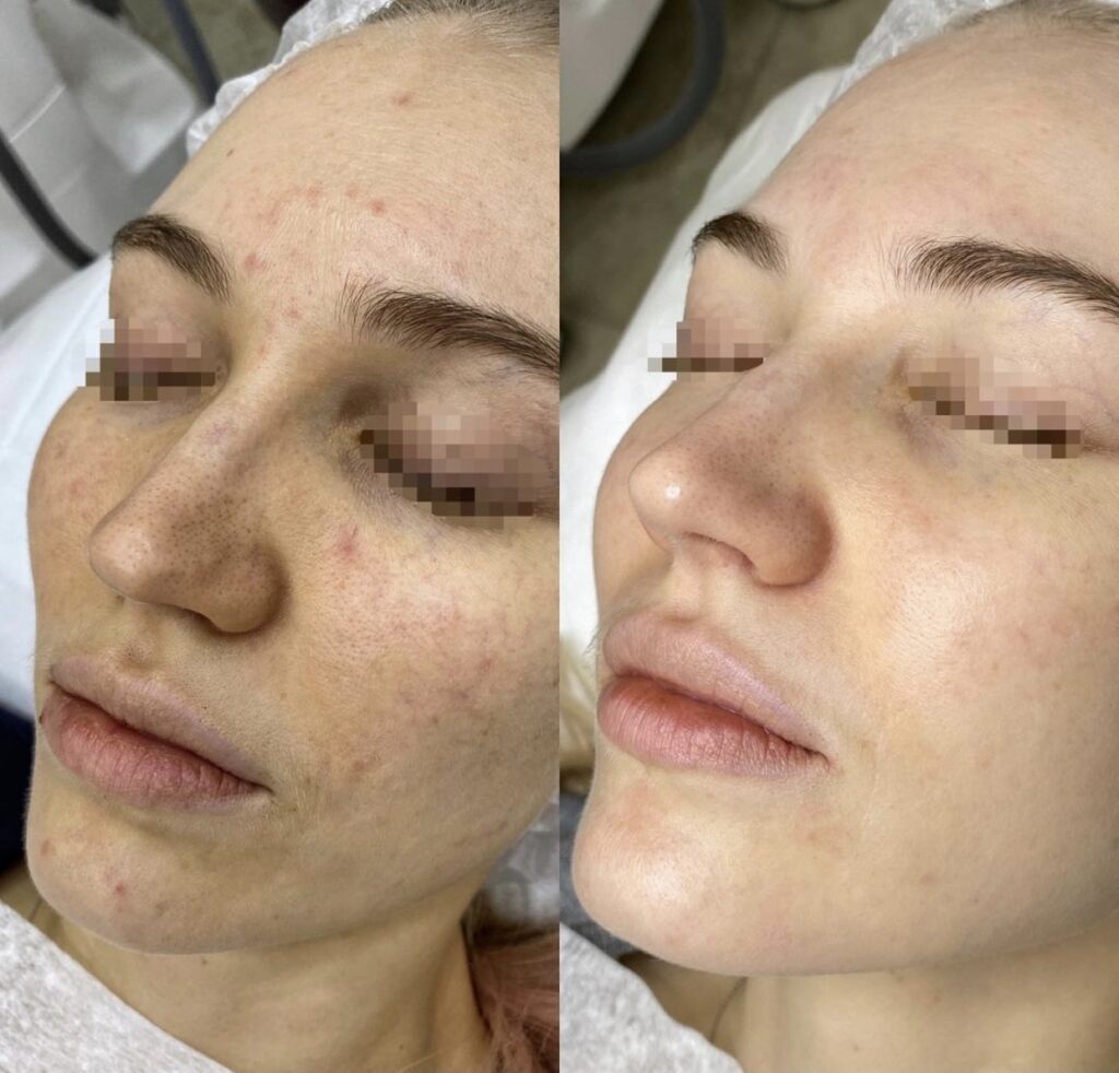 Carbon-Laser-Peel-Before-After-1024x982-1