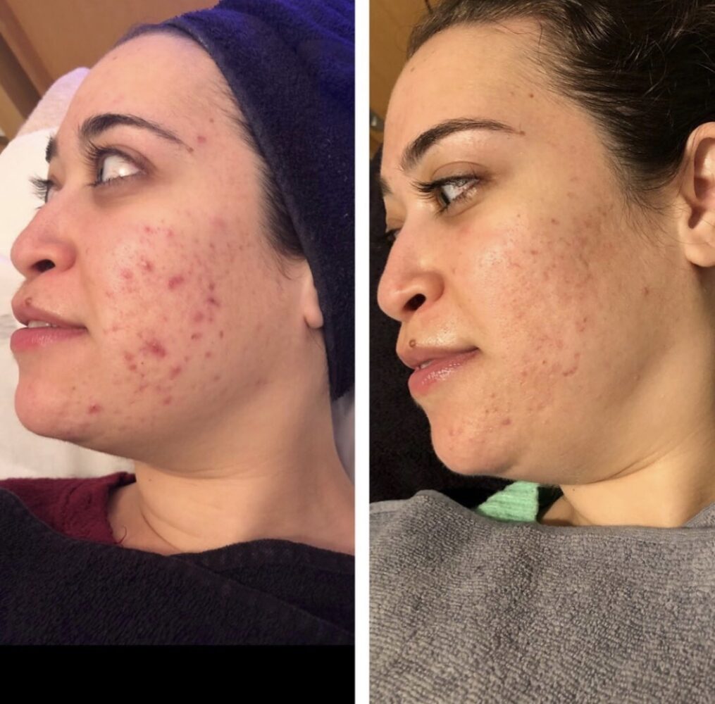 carbon-and-microneedling-treatments-1015x1000