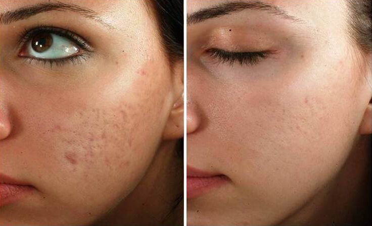 microneedling-session-before-after
