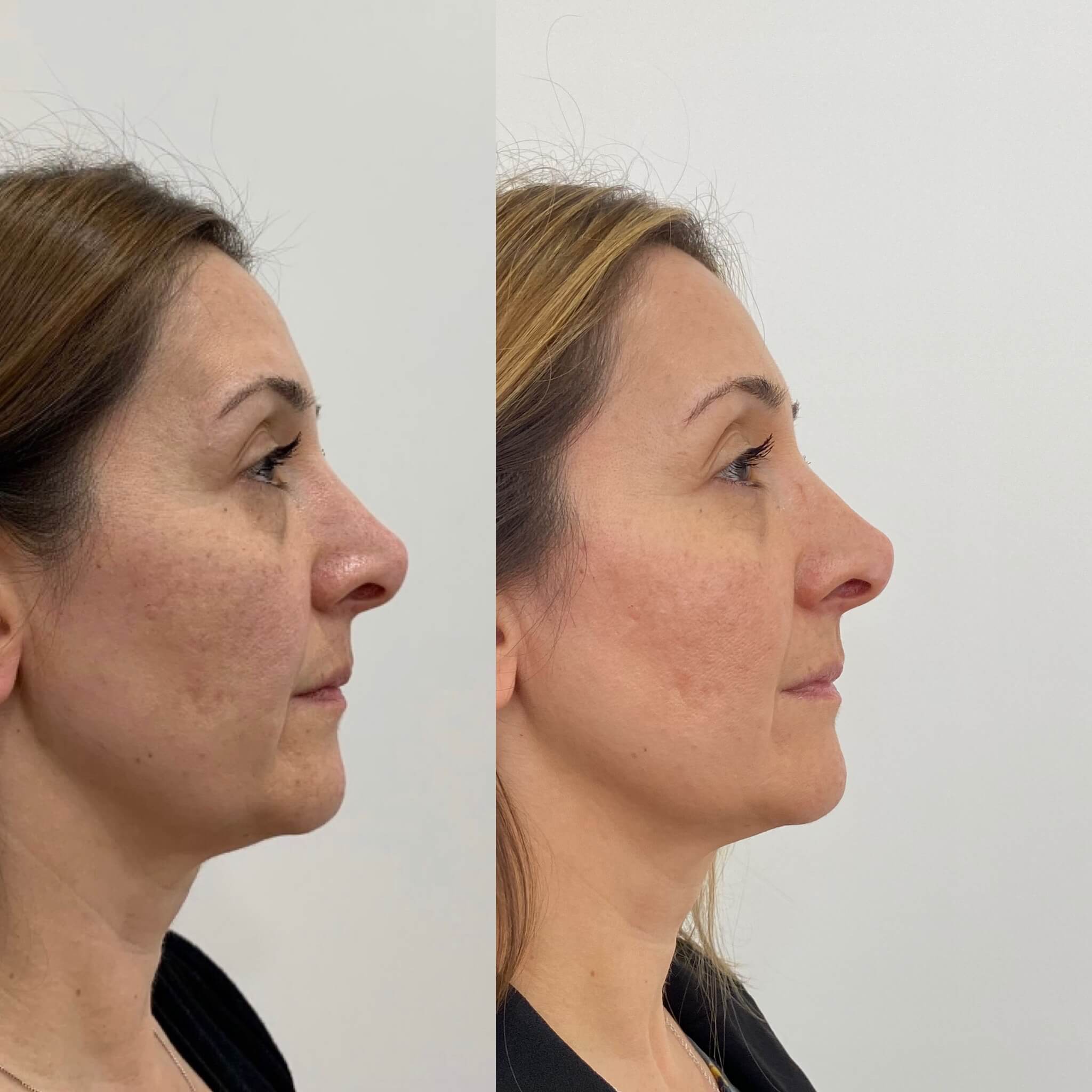 beauty-boost-threadlift-treatments-before-after-carousel-fourtyfive (1)