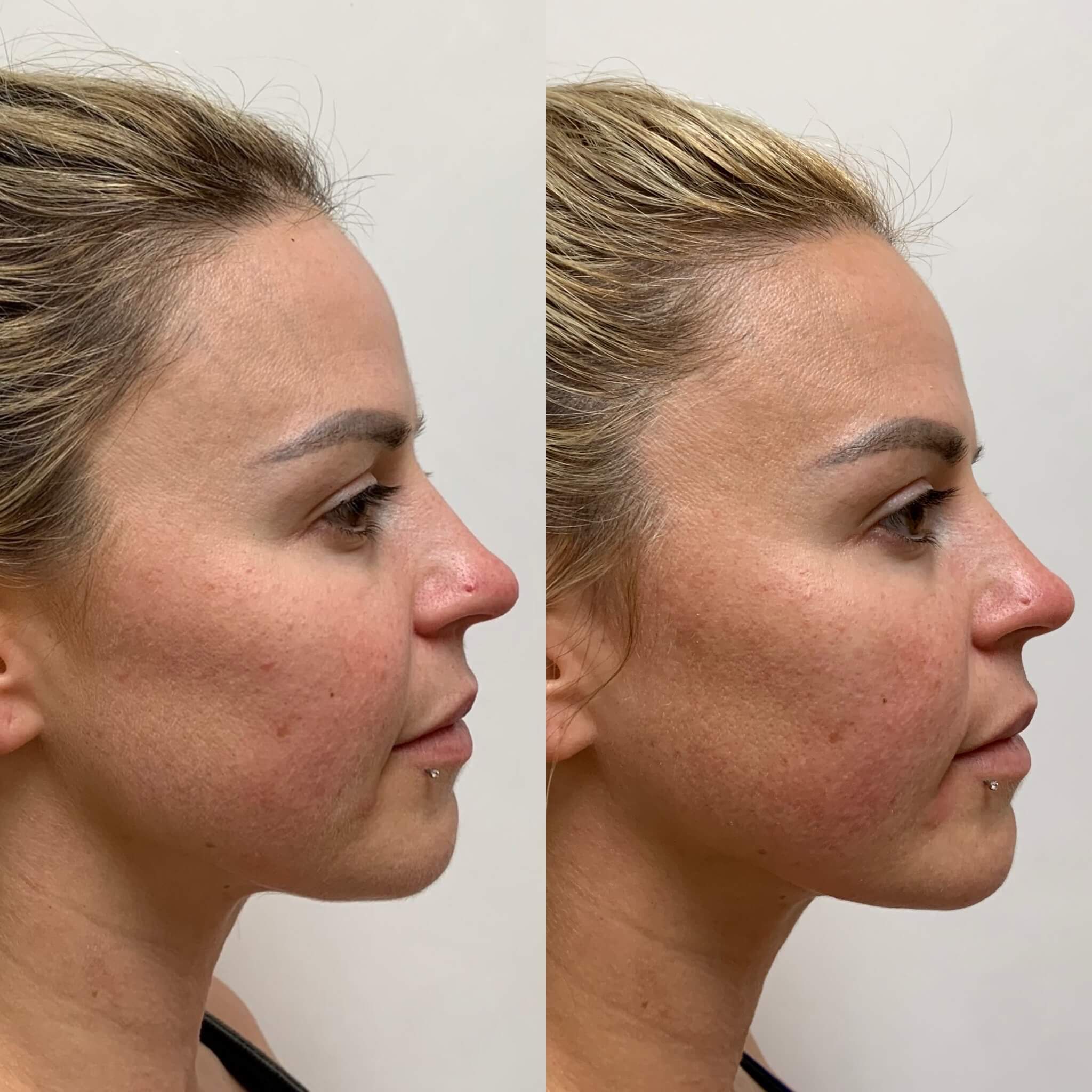 beauty-boost-threadlift-treatments-before-after-carousel-thirtyone