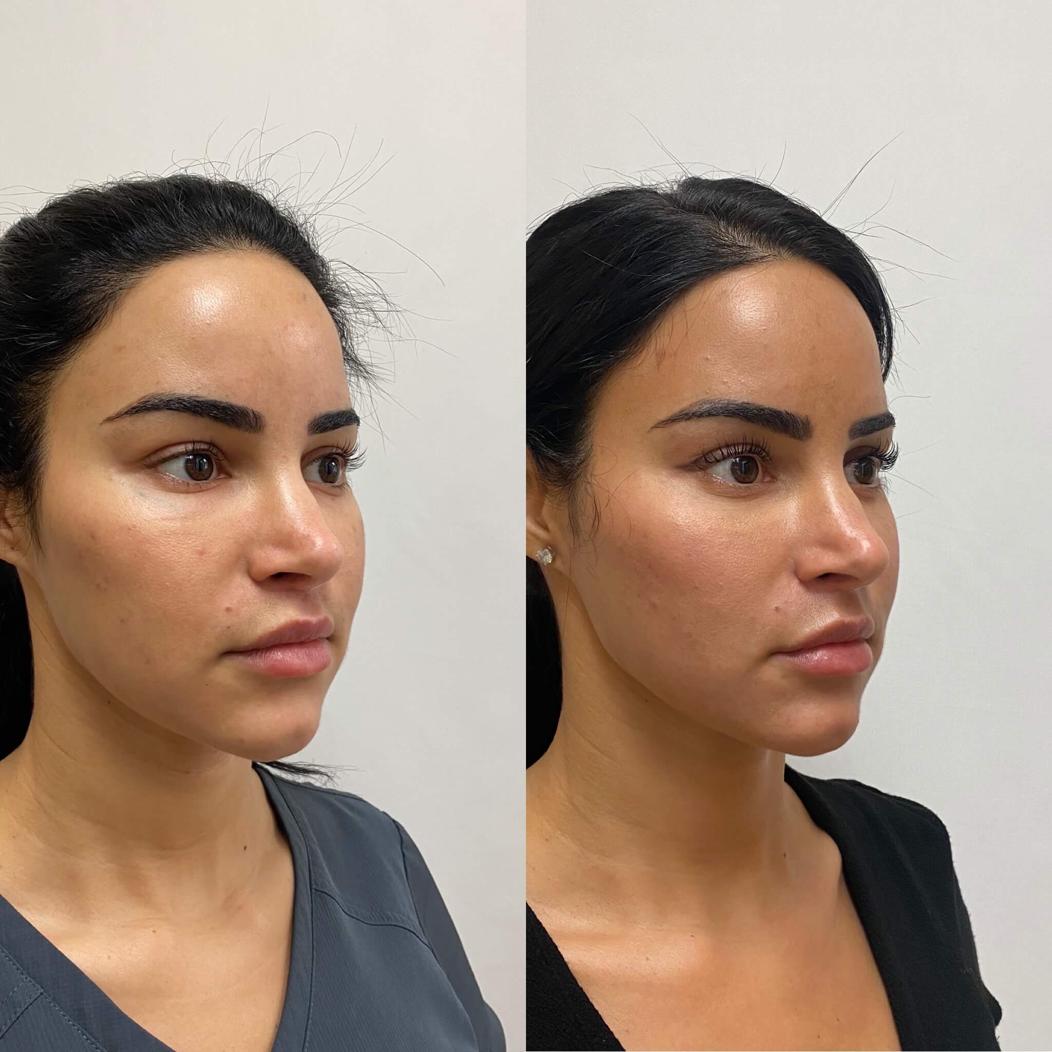 beauty-boost-threadlift-treatments-before-after-carousel-thirtyseven