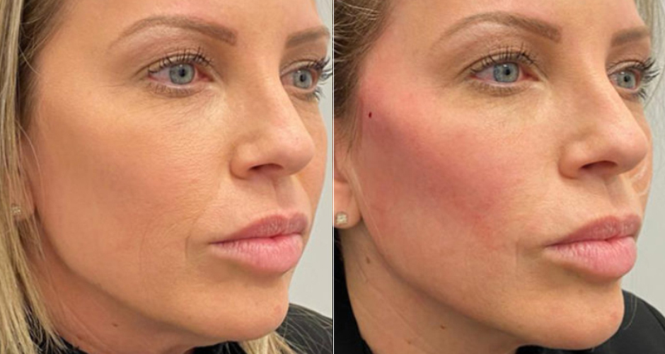 threadlift_v2-gallery