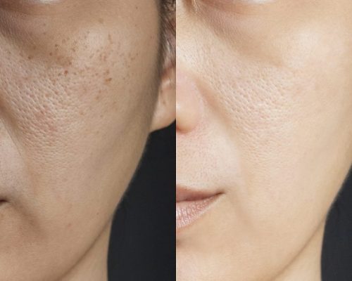 Chemical-peel-healing-process-day-by-day