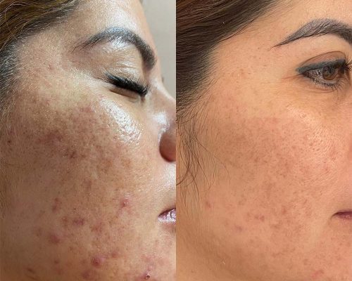 bha-chemical-peel-cover