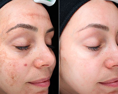 patient-10795-chemical-peels-before-after-scaled