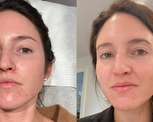 vi-peel-comp-2-1676479542